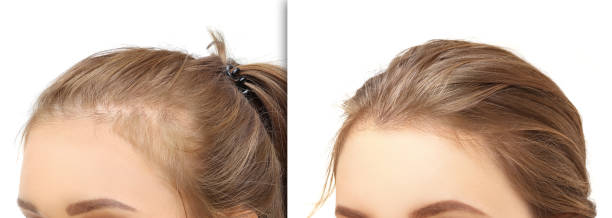 زراعة الشعر في الرياض
