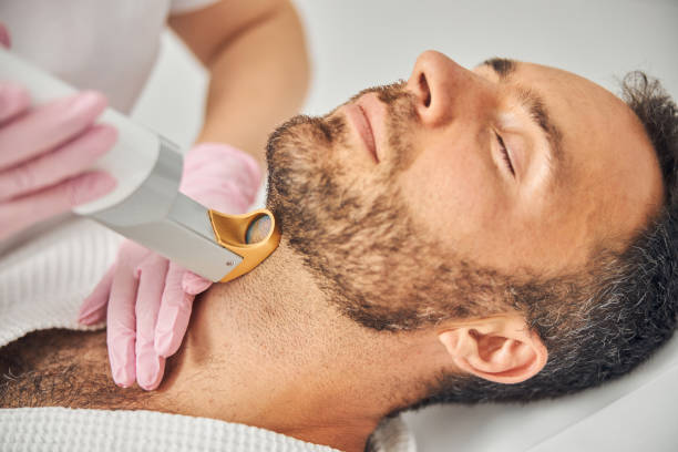Does Beard Laser Hair Removal Remove Ingrown Hair?
