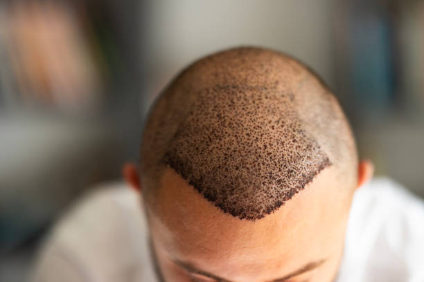 How Effective is Hair Transplant for Balding Men?