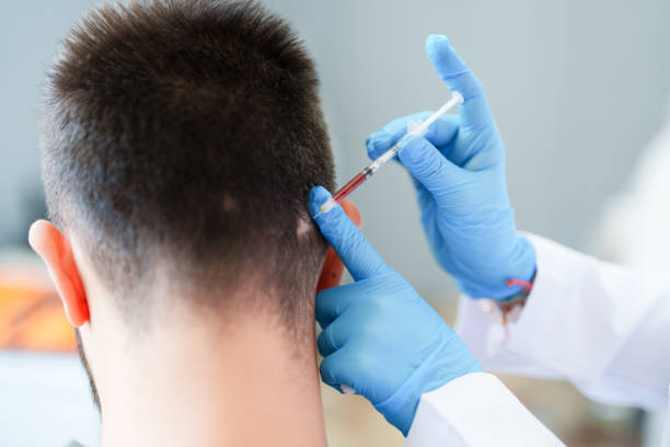 Is PRP Hair Treatment Painful or Easy?