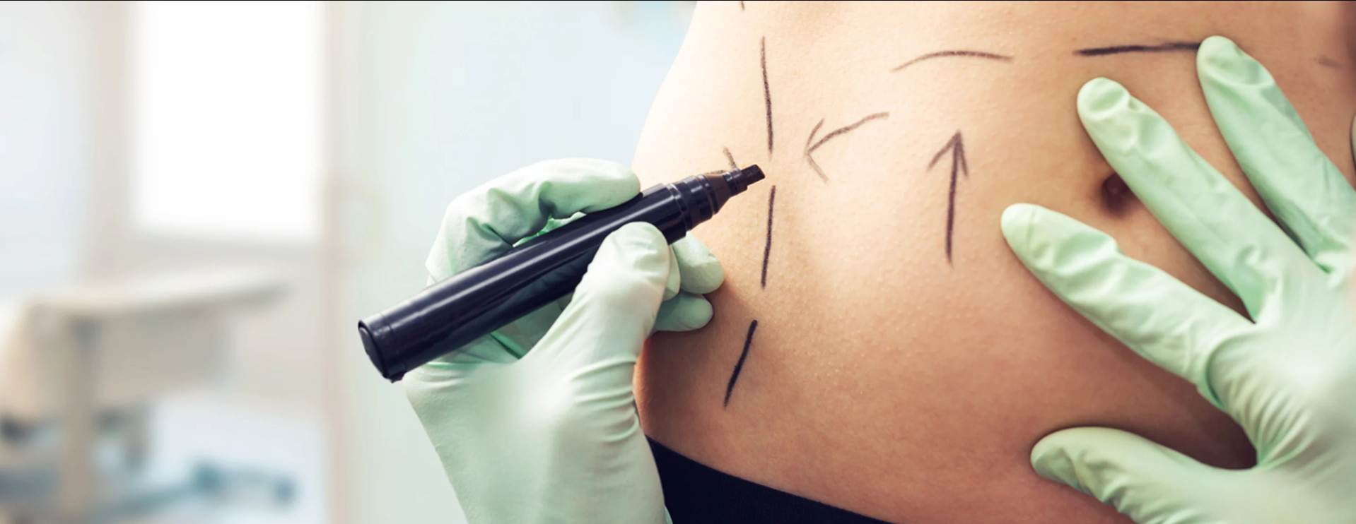 Liposuction in Dubai