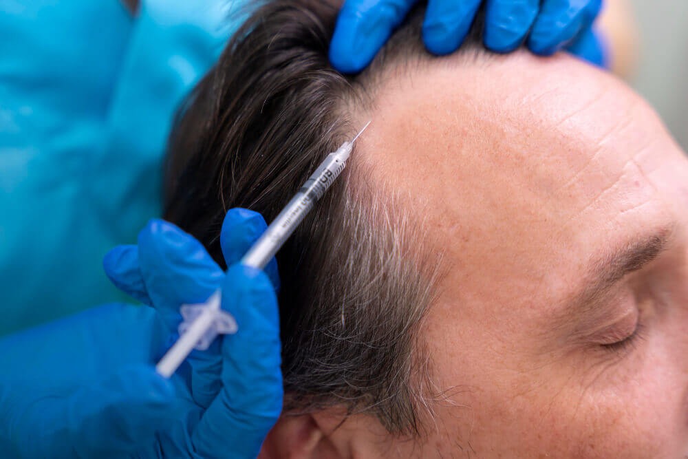 Best PRP Hair Treatment in Dubai