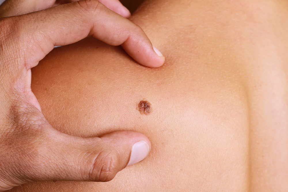 What’s the Cost vs. Benefit of Mole removal treatment in Dubai for Cosmetic Purposes?