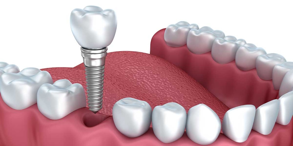 affordable dental implants