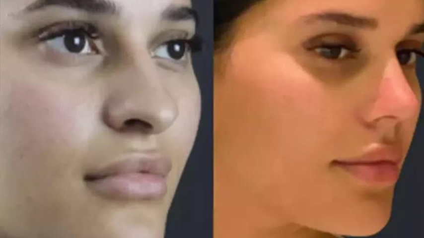 best rhinoplasty surgeon in dubai