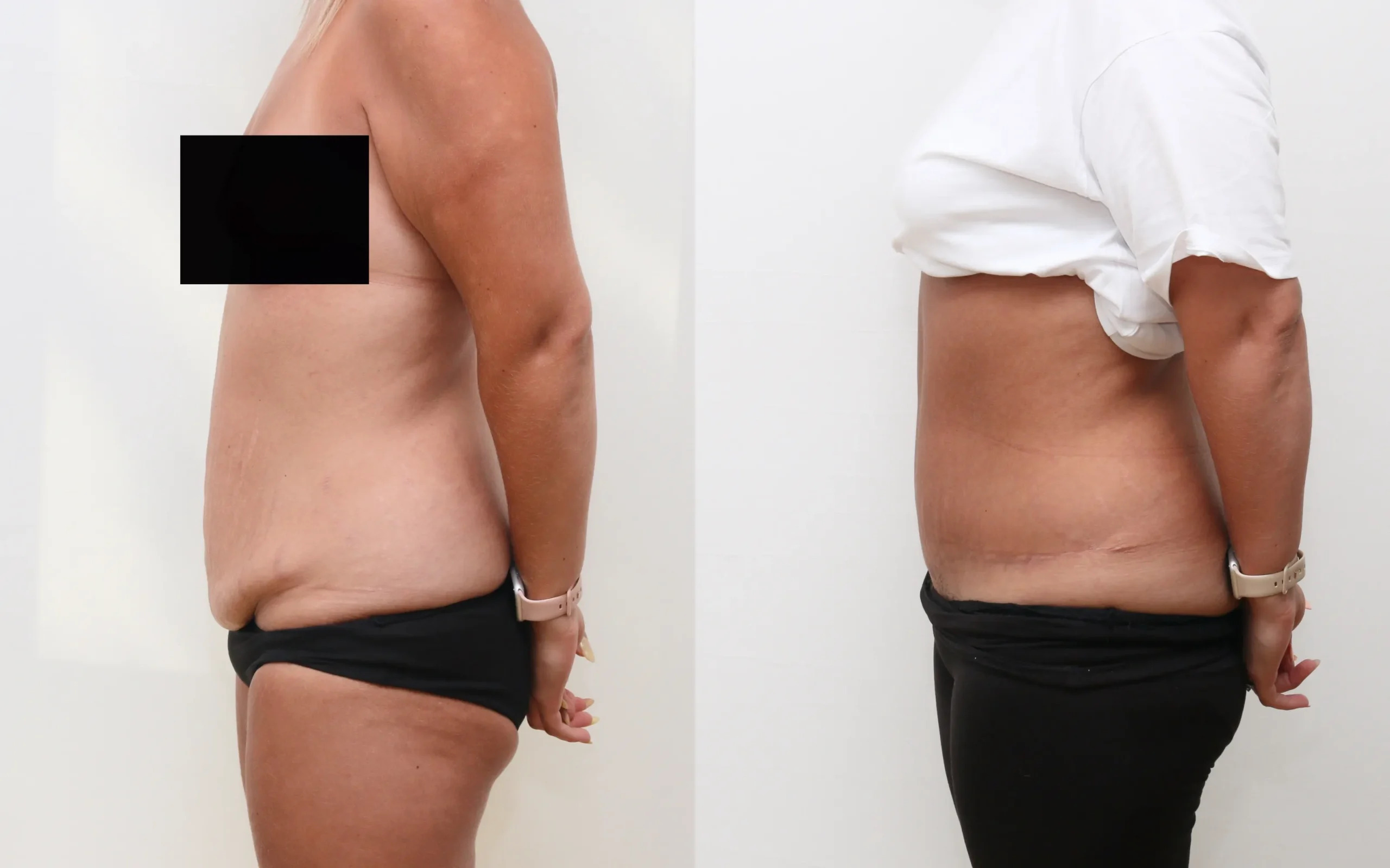 Tummy Tuck in Islamabad