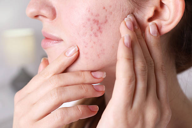 Can Laser Acne Scar Treatment Help With Redness Too