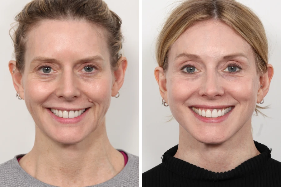 How Often Should You Repeat a Thread Lift? Best Aesthetic Clinic in Dubai Tips