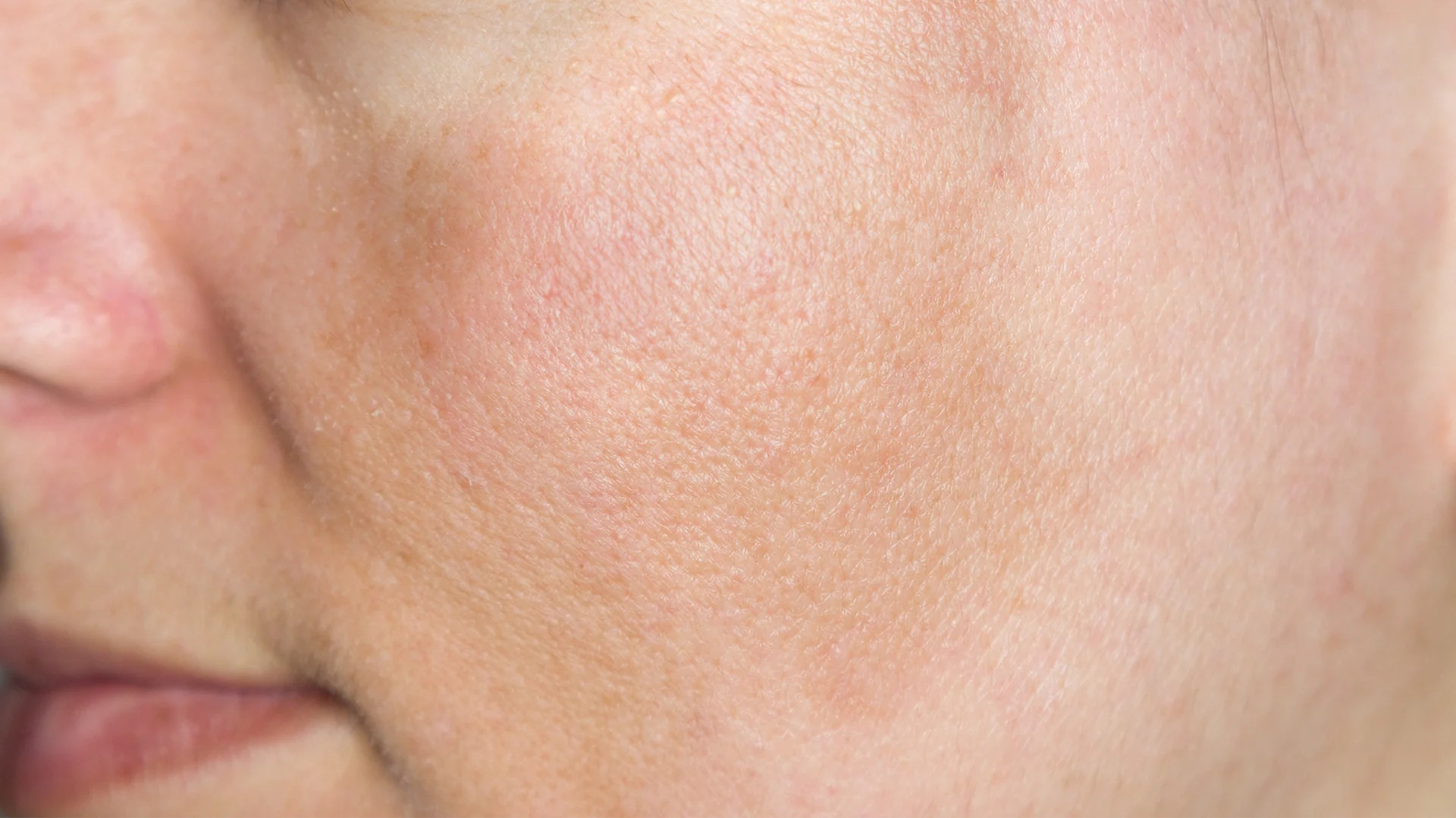 Hyperpigmentation