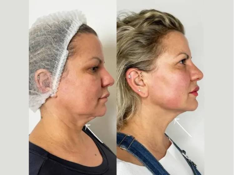 Endolift Treatments in Dubai: Effective Solution for Skin Aging