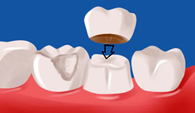 Teeth Crowns