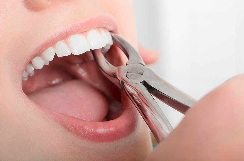 Tooth Extractions in Winslow, AZ