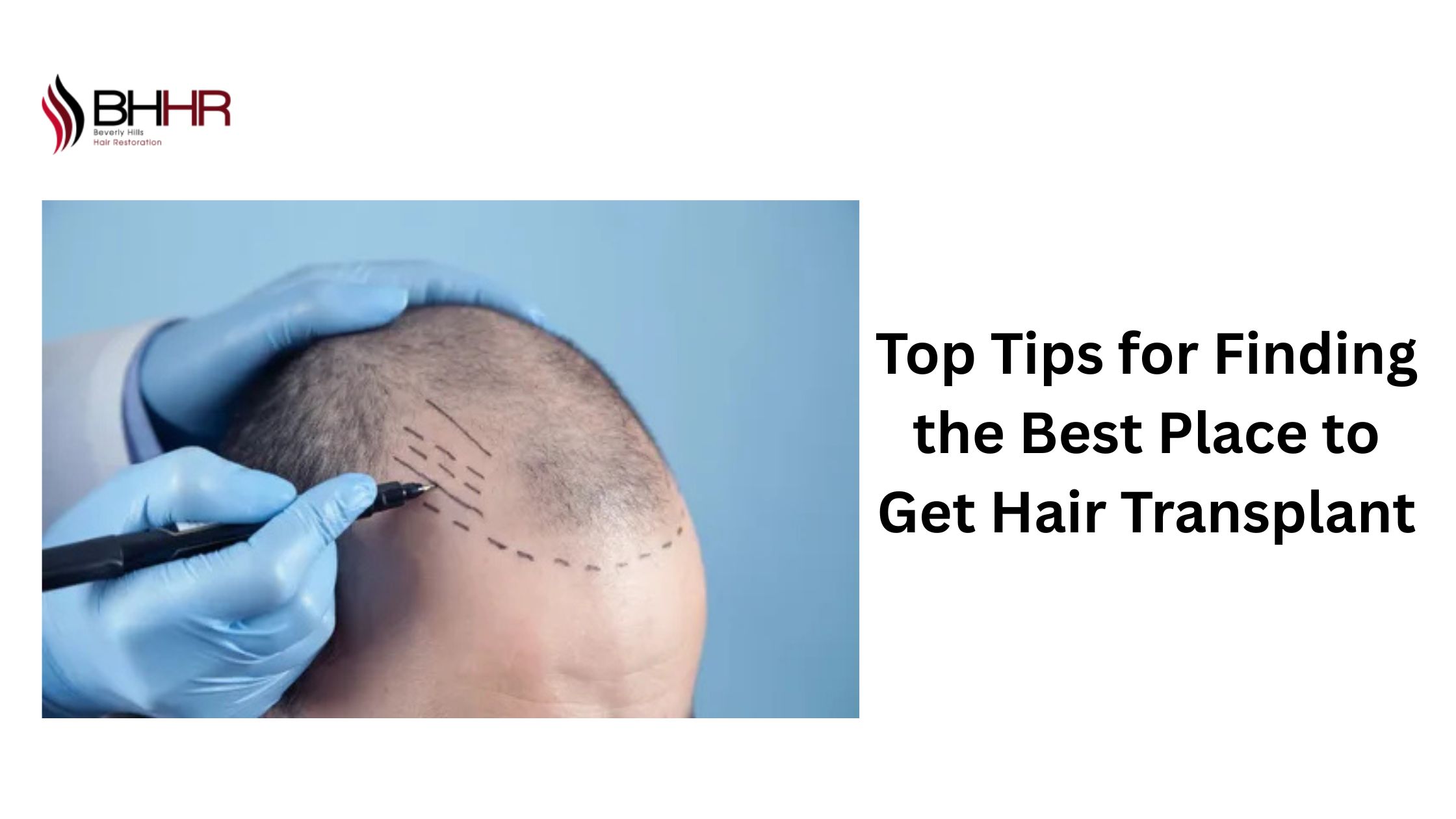 best place to get hair transplant