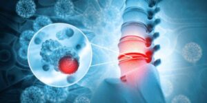 How Spinal Tumors Affect Your Nervous System and Mobility – Insights from a Spinal Tumor Specialist Doctor in Delhi