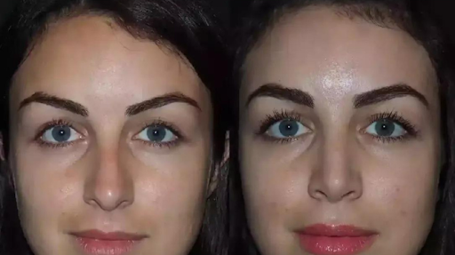 best rhinoplasty surgeon in dubai