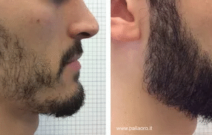 Beard Transplant in dubai