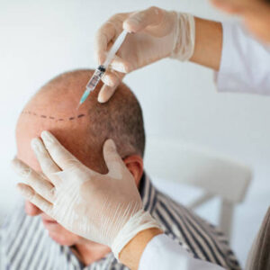 Hair Transplant in Riyadh