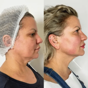 Endolift in Dubai: The Ultimate Anti-Aging Solution