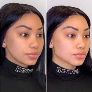 Timeless Beauty Awaits with Thread Lift by Best Doctors in Dubai Experts