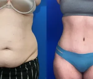 Abdominoplasty in Islamabad