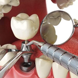 Dental implants glendale