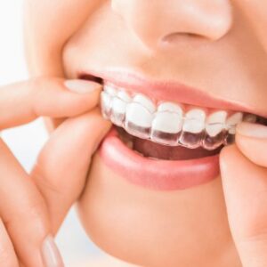 Invisalign Braces Dubai