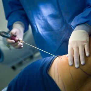 Liposuction in Islamabad