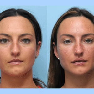 Discover the Best Doctors in Dubai for Thread Lift and Their Signature Techniques