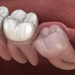 Wisdom Teeth Removal in Paradise Valley, AZ