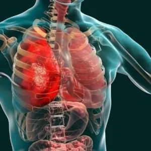 Amoxicillin for pneumonia