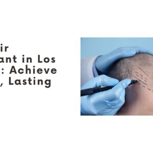 best hair transplant in los angeles