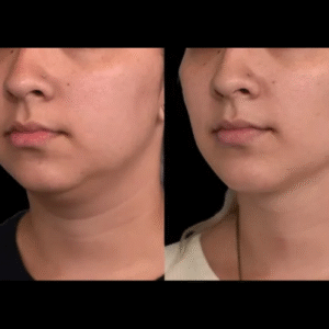 Double chin removal