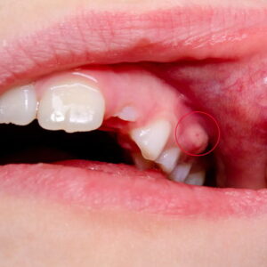 Dental Abscess