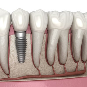 Dental Implants in Lake Havasu City