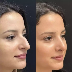 septoplasty in dubai