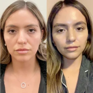 Achieve Natural, Youthful Beauty with the Best Thread Lift Treatment in Dubai