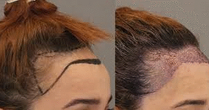 Hair Transplant in Dubai