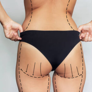 Liposuction surgery in Riyadh