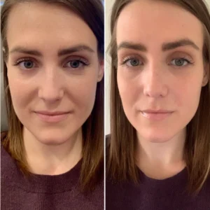 PRP Treatment in Dubai