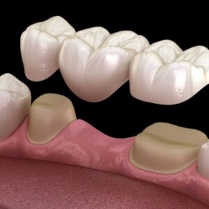 Dental Bridges in Chandler, AZ