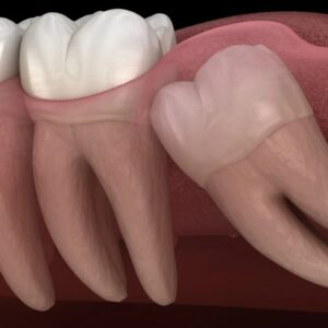 Wisdom Teeth Removal in Chandler, AZ