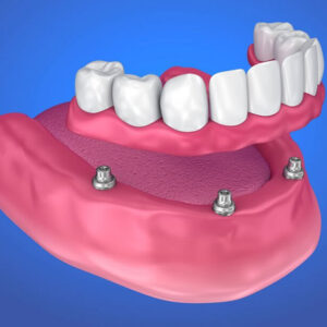 Dentures in Glendale, AZ
