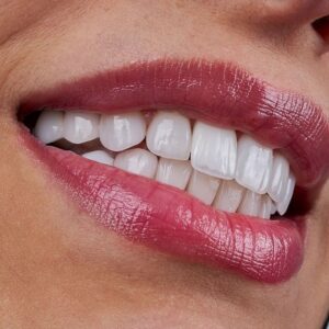 Tooth Bonding in Surprise, AZ