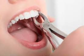 Tooth Extractions in Phoenix, AZ