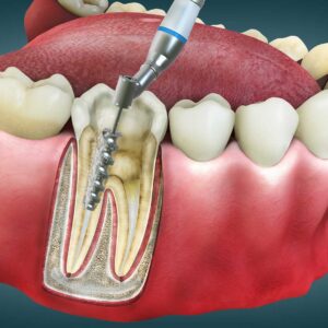 Root Canal Treatment in Hayward, California
