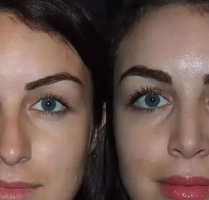 rhinoplasty in dubai