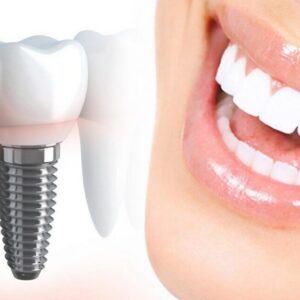 Dental implants in Islamabad