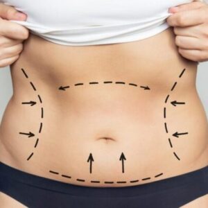 vaser liposuction in dubai