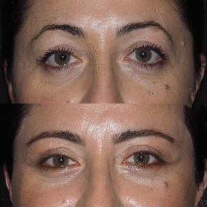 Eye Bag Removal in Dubai