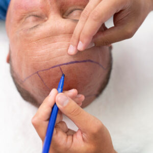 Man getting a hair transplant